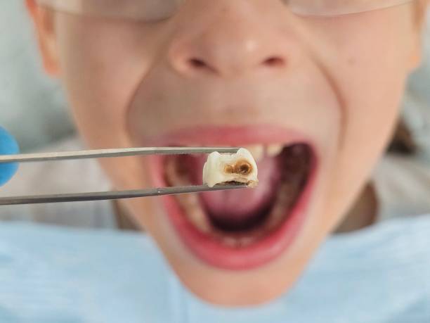 Best Emergency Treatment for Dental Infections or Abscesses in Hardwick, GA